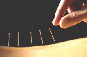 tecnica-de-acupuntura