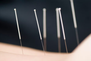 tratamientos acupuntura